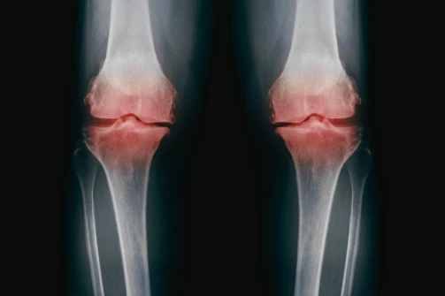 Genoux avec arthrose